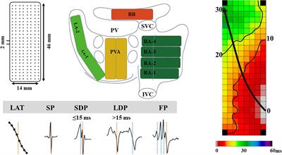 Signal Fingerprinting as a Novel Diagnostic Tool to Identify Conduction Inhomogeneity